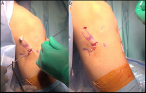 A) Paso de injerto desde inserción femoral por túnel de partes blandas, debajo de la banda iliotibial. B) Paso del injerto por el túnel tibial.