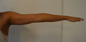 Porción anterior del brazo en abducción. Al realizar abducción del hombro se encuentra una atrofia aparente de la porción larga del músculo bíceps braquial.