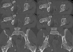 Tomografía computarizada multicorte de cadera derecha al ingreso sin rasgo de fractura visible a nivel del cuello femoral. Las flechas indican la ausencia de rasgo de fractura a nivel del cuello femoral.