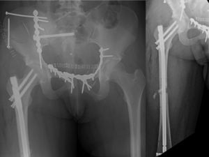 Radiografía de control de reducción y osteosíntesis de fractura de diáfisis y cuello femoral.