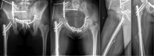 Radiografías de control a las 6 semanas posreducción y osteosíntesis.