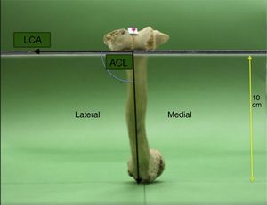 En esta figura se observa una muestra ósea humeral colocada sobre el área de medición. La cara anterior del segmento distal humeral se apoya en una superficie paralela al suelo, con una elevación de 10cm para permitir visión simultánea del húmero proximal y distal. Ambas flechas se originan en el segmento más lateral de la tróclea del codo. La flecha horizontal sigue la LCA y la flecha vertical está dirigida al labio lateral del SB. El ángulo formado entre estas flechas representa el ACL. ACL: ángulo complementario lateral; LCA: línea intercondílea anterior.