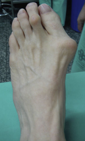 Imagen clínica típica de un hallux valgus.