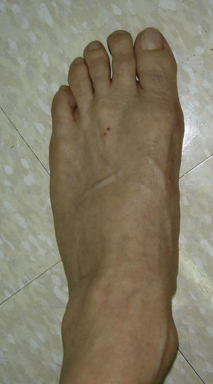 Imagen clínica de un hallux valgus postoperado.