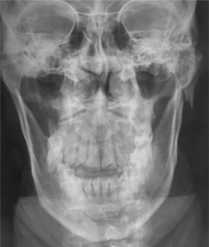 Radiografía PA de Cráneo.