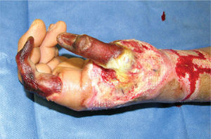 Hombre 34 años, quemadura eléctrica alto voltaje mano izquierda. Necrosis de pulgar e índice.