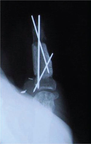 Detalle de la reconstrucción ósea del pulgar, con injerto de cresta iliaca intercalado. Estabilización con agujas de Kirschner.