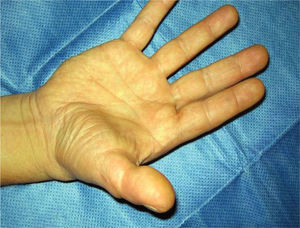 Imagen de la mano a los 5 años de la reconstrucción.