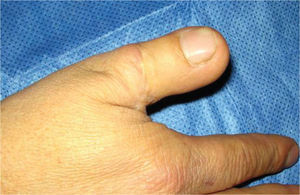 Imagen de la mano a los 5 años de la reconstrucción.