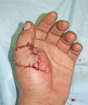 Reimplante pulgar, imagen post operatorio inmediato.