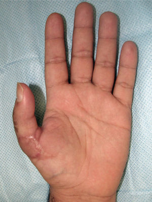 Mano izquierda a los 4 meses del reimplante.