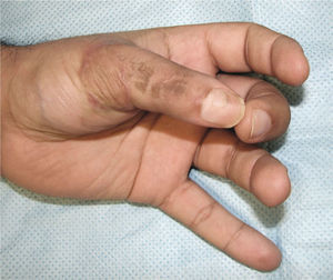 Mano izquierda a los 4 meses del reimplante