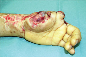 Mano izquierda luego de resección de pulgar a nivel de metacarpiano e índice. Se realiza en el mismo acto una cobertura con colgajo interoseo posterior.