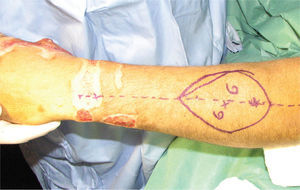 Antebrazo izquierdo con colgajo tomado, zona dadora con injerto de piel.