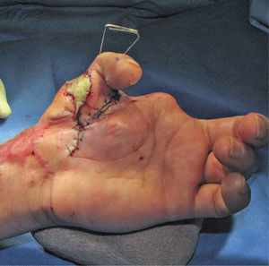 Reconstrucción de pulgar con transferencia de segundo ortejo.