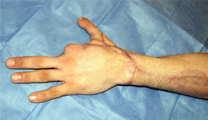 Reconstrucción de pulgar izquierdo a los 10 meses.