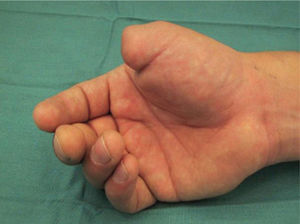 Hombre, 40 años, amputación pulgar derecho a nivel falange proximal.