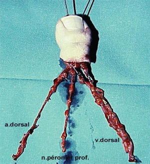 Reconstrucción de pulgar con técnica Wrap-Around. Imagen de colgajo compuesto listo para transferir.