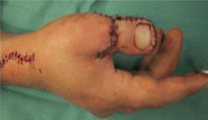 Pulgar reconstruido, imagen post operatoria inmediata.