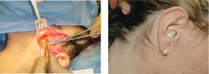 Lifting “corto” de incisión pre-pilosa (patilla). Disección y cicatriz