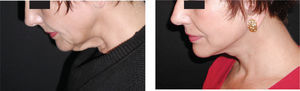 Lifting convencional con miorrafia anterior del platisma.