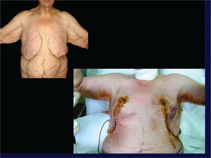 El mismo paciente después de su plastia mamaria y braquioplastía bilateral.