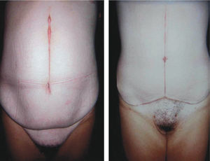 Paciente sometida a Abdominoplastía vertical un año después de su cirugía bariátrica. Bajó 52kg.
