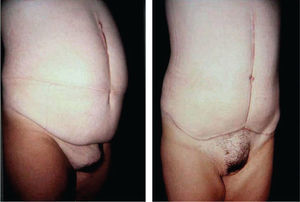 Paciente sometida a Abdominoplastía vertical más puboplastía.