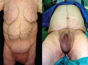 >Hombre operado un año antes, sometido a varias plastias post cirugía bariátrica. Paciente después de su plastia de abdomen y pubis.