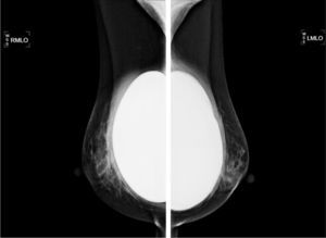 Mamografía bilateral con implantes en ubicación retropectoral de morfología y contorno conservado.