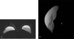 Resonancia mamaria: secuencia específica para visualización de silicona (STIR con saturación de grasa y agua) axial (A) y sagital (B) que muestran el signo de linguini.