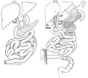 Figure 1. Injerto Figure 2. Trasplante aislado de intestino Figure 3. Trasplante de hígado e intestino con preservación de páncreas. Figure 4. Trasplante multivisceral.