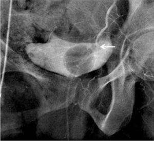 Control angiográfico post-embolización con gelita. Se observa ausencia de extravasación de contraste y obstrucción de parte de la rama cérvico-vaginal (flecha).