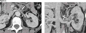 Tomografía computada con medio de contraste: corte axial y reconstrucción a nivel de las venas renales. Se observa un defecto de llene parcial en la vena renal izquierda, con las características de un trombo (flechas).