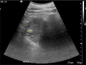 Imagen de Ultrasonido en polo superior de riñón derecho, en que se identifica una lesión hiperecogénica nodular.