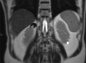 Corte coronal secuencia T2. Se identifica una lesión nodular hipointensa con centro hiperintenso en el polo superior del riñón derecho.