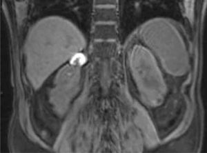 Corte coronal secuencia T1 con saturación grasa. Se identifica un nódulo hiperintenso con centro hipointenso en el polo superior del riñón derecho.