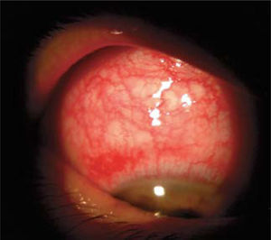 Conjuntivitis alérgica, se aprecia quemosis y ojo rojo.
