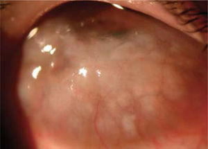 Papilas limbares que comprometen el eje visual en un paciente con queratoconjuntivitis vernal.