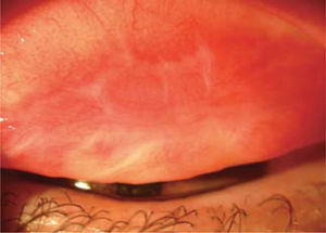 Cicatrices tarsales en paciente con Queratoconjuntivitis atópica.