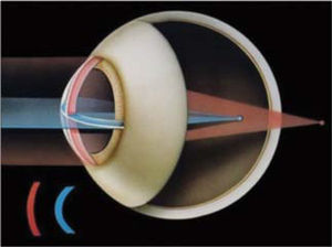 Astigmatismo. www.ocularis.es; Astigmatismo y formación de imágeens en la retina. Dr. O. García.