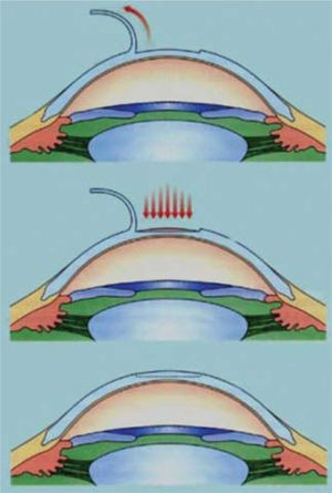 LASIK para la correción de miopía. www.ocularis.es; Dr. R. Pascual.