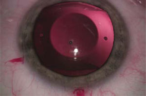 LIO-f de cámara posterior.
