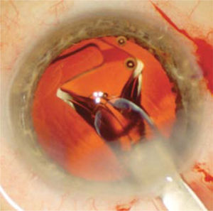 Se observa el LIO comenzando a expandirse dentro del saco capsular a medida que es inyectado a través de la herida operatoria. Este despliegue es suave y controlado para evitar dañar el saco capsular.