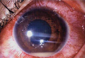 Paciente varón de 28 años con uveitis HLA B27. Nótese la presencia de hipopion en la cámara anterior