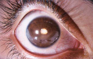 Queratopatía en banda (depósitos cálcicos corneales), con sinequias posteriores y catarata en paciente con AJI.