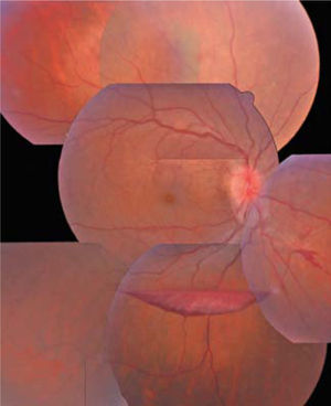 Fotomontaje del fondo de ojos de una paciente de 58 años portadora de sarcoidosis. Nótese la hemorragia subhialoidea en forma de bote producida por la rotura de vasos anormales de neoformación secundario a la isquemia retinal producida por la vasculitis. Además en nervio óptico aparece con hiperemia y bordes algo difuminados (papilitis).