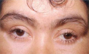 Paciente portador de enfermedad de Vogt Koyanagi Harada en etapa crónica. Destacan cejas canas y poliosis (pestañas canas).