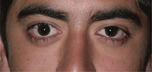 Foto de paciente adolescente con exoftálmo y retracción palpebral.