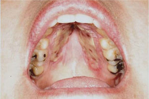 Foto de la cavidad oral del paciente donde se aprecia la zona de toma de injerto del paladar.